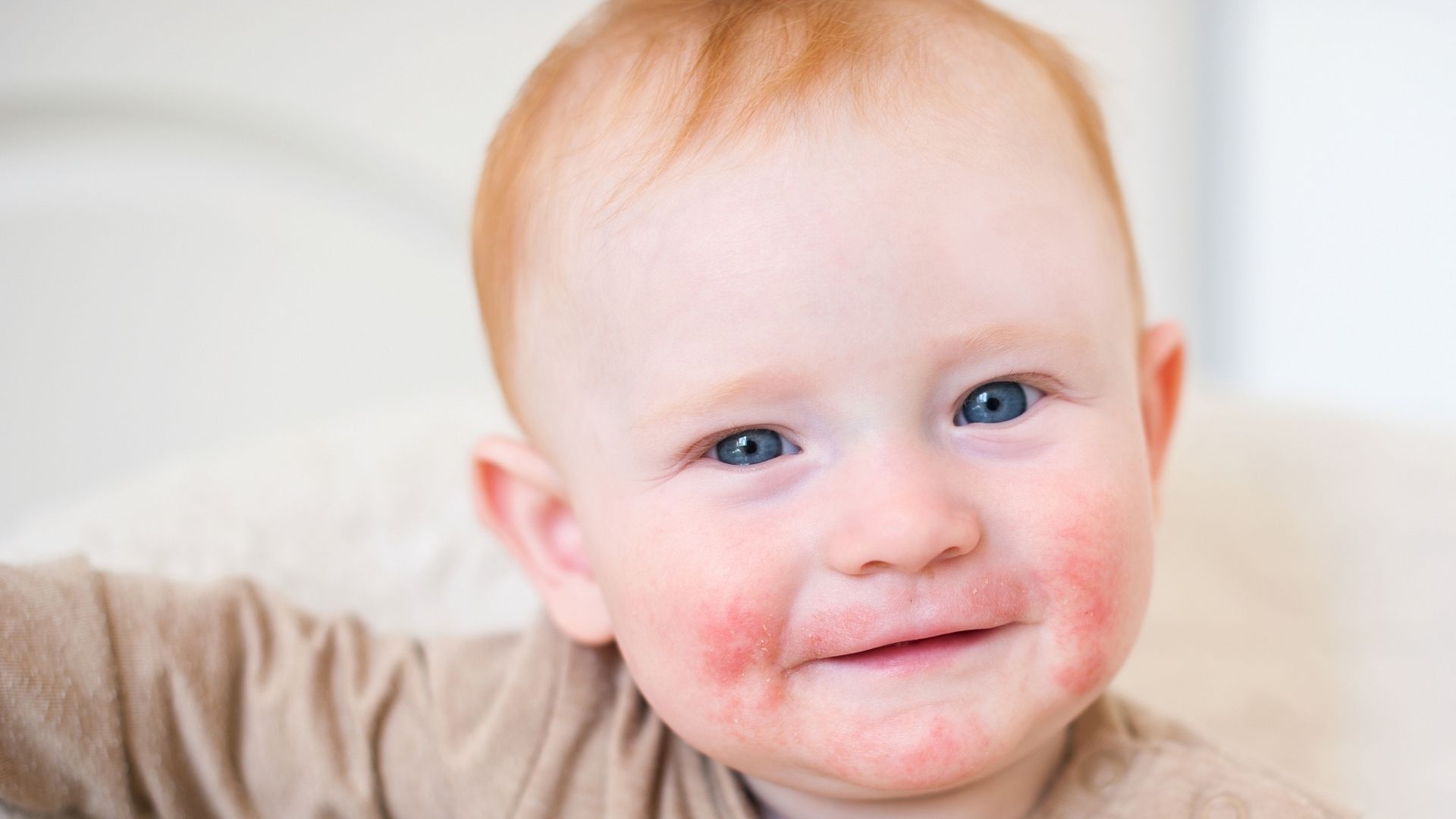 Dermatite atopique chez l'enfant, conseils à l'officine
